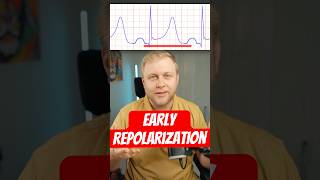 Is It A Stemi? Early Repolarization Stemi Mimic