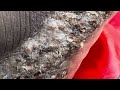 Hamza’s last jigger digging right foot - see full video @riseupsociety.net