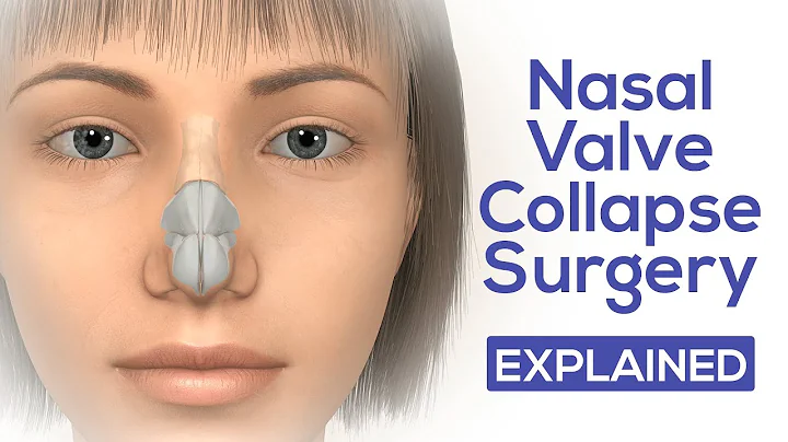 Nasal Valve Collapse Surgery Explained | Dr. Moust...