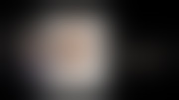 Laparoscopic Liver Resection for segment V - Hepatocellular Carcinoma by Dr Hitesh Chavda