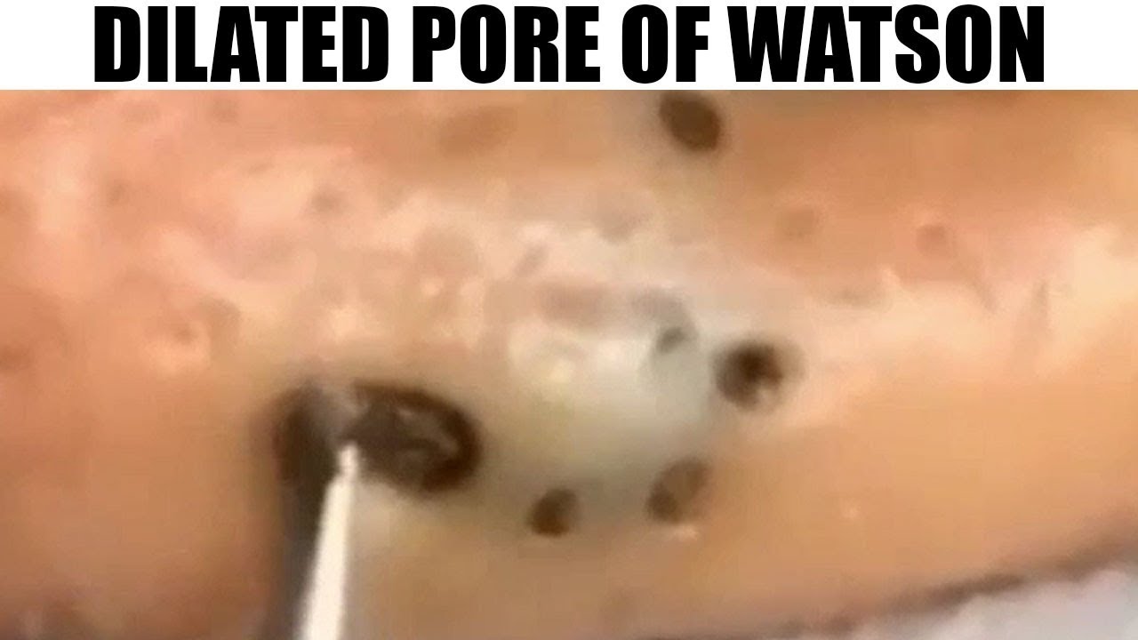 The Biggest Dilated Pore Of Winer