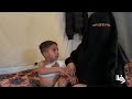 الطفل معين الغلاييني من غزة مصاب بحروق شديدة ويحتاج لعمليات جراحية وعلاج ترميمي
