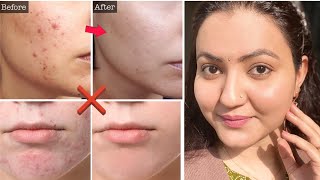 मुश्किल से मुश्किल मुंहासे PIMPLES, ACTIVE ACNE, Dark Spots का करें 100% इलाज और पाएं बेदाग Skin screenshot 5