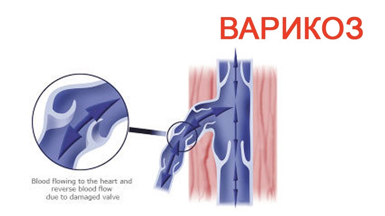 Расширение вены семенного канатика. Варикоз вен семенного канатика. Варикозное расширение вен мошонки. Расширение вен семенного канатика.