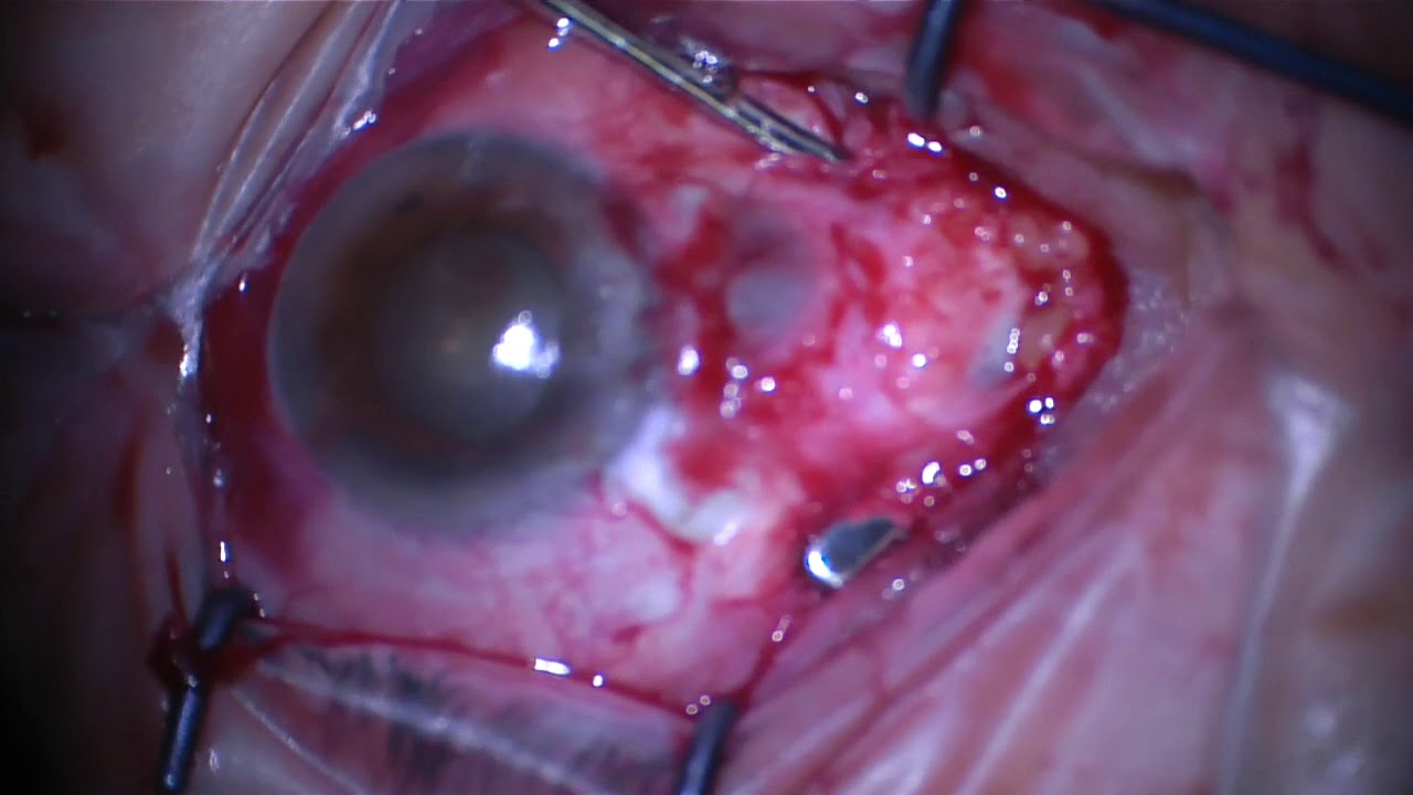 Restrictive Strabismus after Recurrent Pterygium