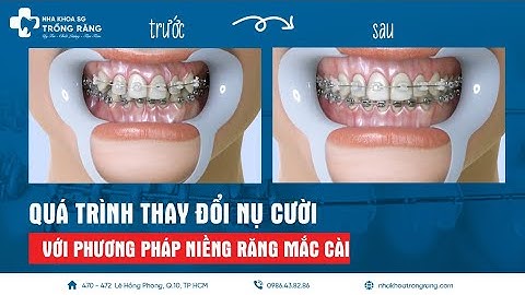 Niềng răng mắc cài | Quá trình thay đổi nụ cười