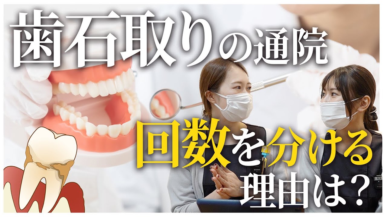 歯石取りで回数を分けるのはなぜ？大切な理由があります！【名古屋茶屋歯科・矯正歯科】