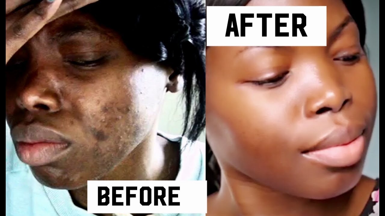 ACNE TREATMENT - HOW I GOT RID OF MY ACNE / COMO CUREI MINHA ACNE - YouTube
