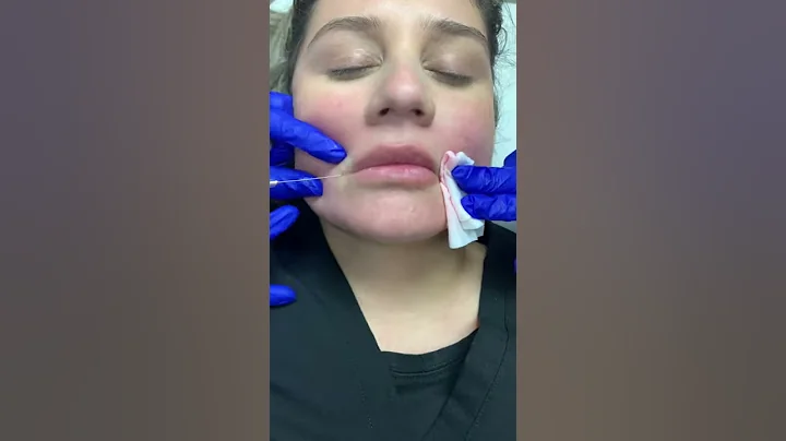 Fort Worth Texas Dermatologist demonstrates lip in...