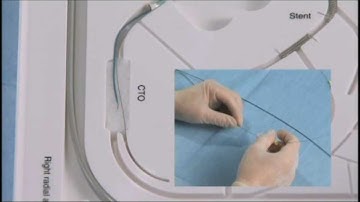 Angioplasty technique: parallel wire