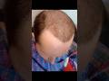 Hair Transplant Review- 5,000 Grafts Hattingen Hair