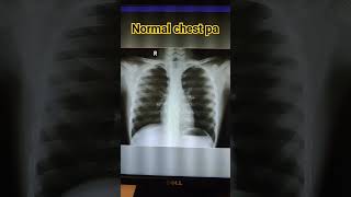 X Ray Chest