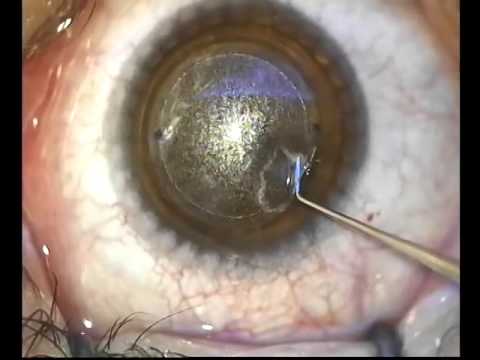 miopia astigmatismo cirugia cum se restabilește vederea cu linguri