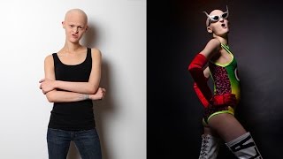 Genetic Disorder Sufferer Defies Critics To Become International Model