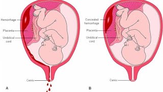 Signs and symptoms of placenta separation or placental abruption