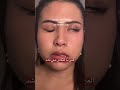 Paralysie Faciale التهاب العصب السابع شلل نصف الوجه Tanger Morocco Kinesithérapie رياضة 