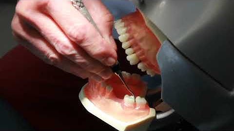 Use of Posterior Sickle Scalers