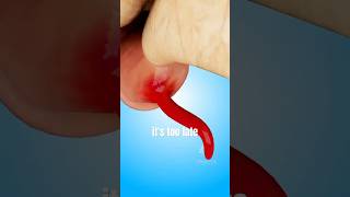 Inside a Burst Appendix Surgery 😱 #appendectomy