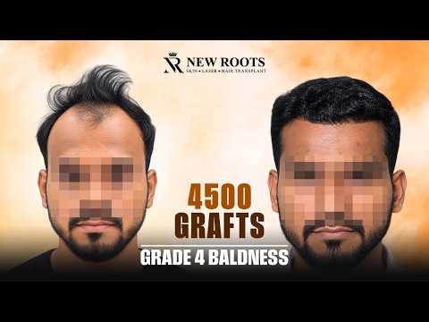 The Hair Transformation Is HARD TO BELIEVE! 😮 | Grade 4 Baldness | 4500 Grafts | Cost | Mumbai