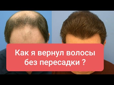 Новый способ роста волос без пересадки! ЛЫСИНА ЗАРАСТАЕТ! Как остановить выпадение волос и облысение