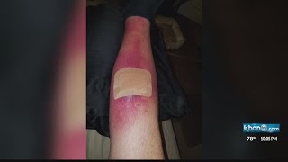 Spider bite lands Kapolei man in hospital