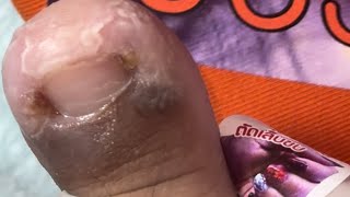Ep_6087 *Ingrown toenail removal  หนูตัดเข้าซอกตลอด..เล็บมันจึงจม  (clip from Thailand)