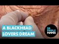 A blackhead lovers dream