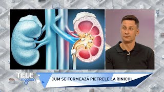 : Ce formeaza pietrele la rinichi, ce dureri provoaca si cum pot fi eliminate