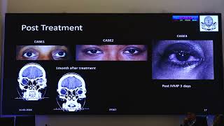 AIOC2026   FP307   T Dr Anugya Deep Three Faces of Orbital Pseudotumor  A Case Series and Review of