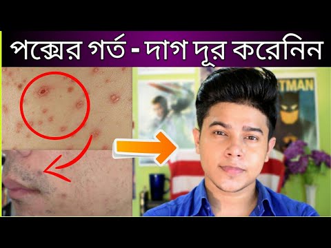 ভিডিও: চিকেন পক্সের দাগ প্রতিরোধের সহজ উপায়: 10 টি ধাপ (ছবি সহ)