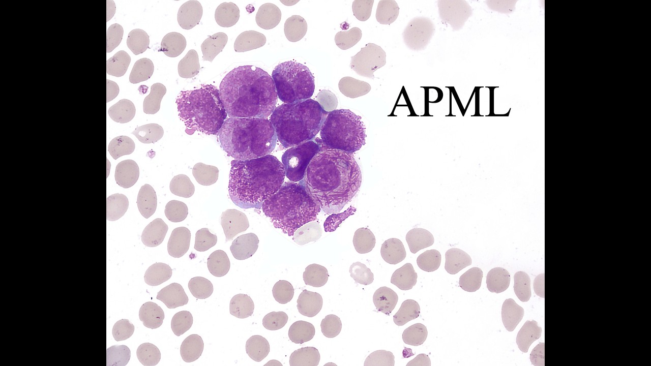Acute Promyelocytic Leukemia (APML): Workup and Management - YouTube