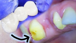 Full Dental Bridge Procedure Step by Step Including the Extraction on a Badly Infected Molar!