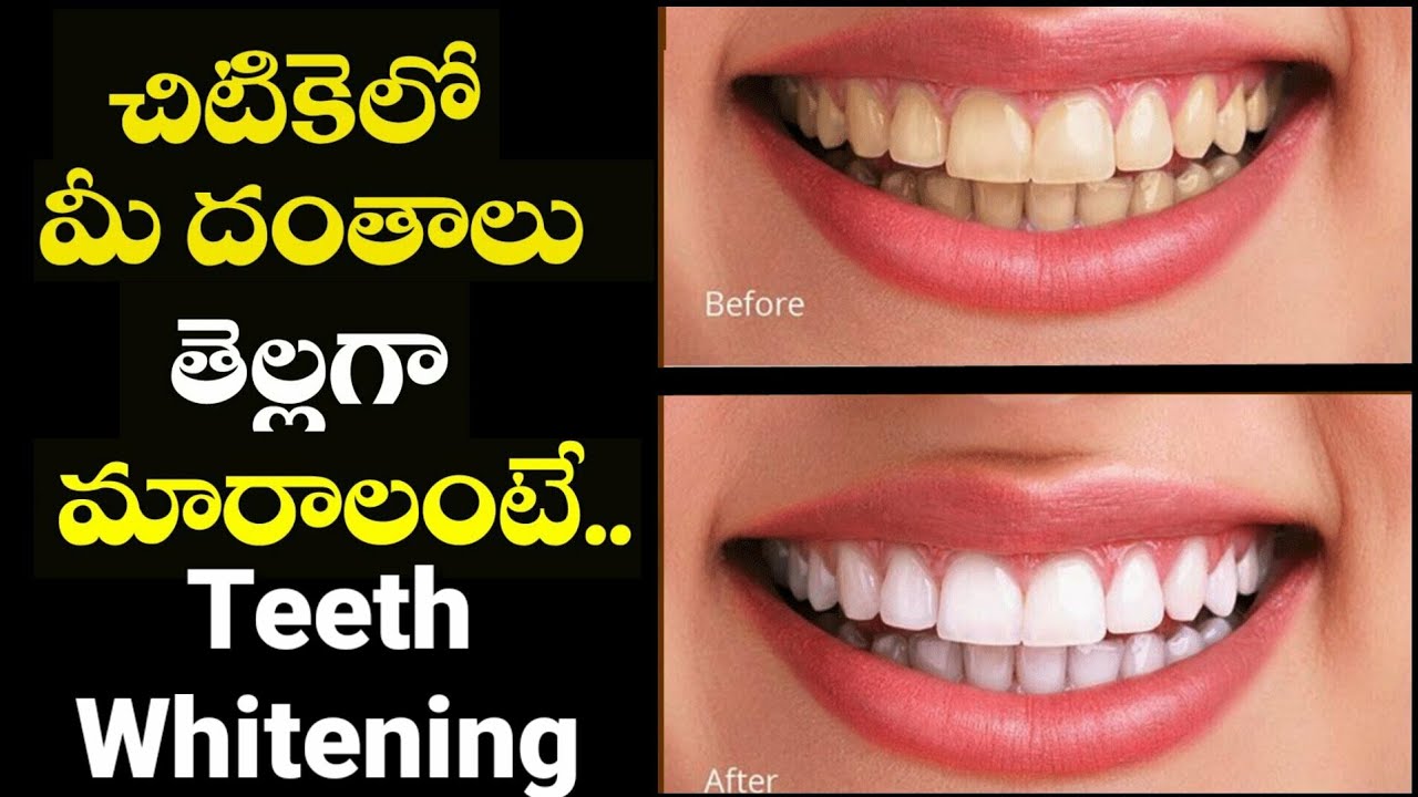 How To Whiten Teeth In Just 2 Minutes In Telugu / white your teeth at