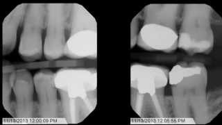 Tips and Tricks for Bitewing XRays