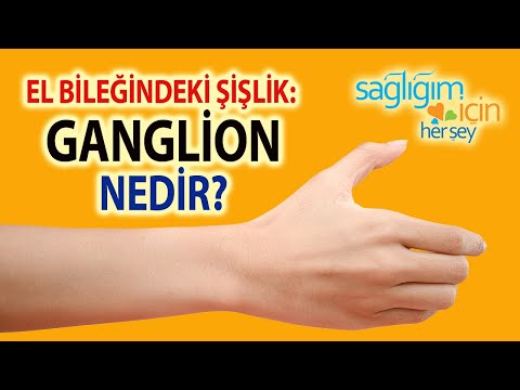 El Bileğindeki Şişlik: Ganglion Nedir?