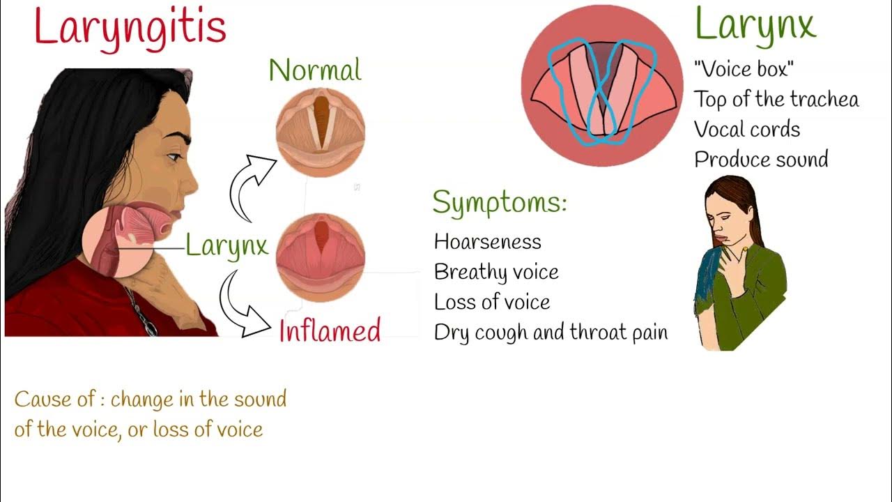 Laryngitis Symptoms Causes And Treatment Youtube