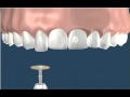 Dentistry recontouring teeth 1