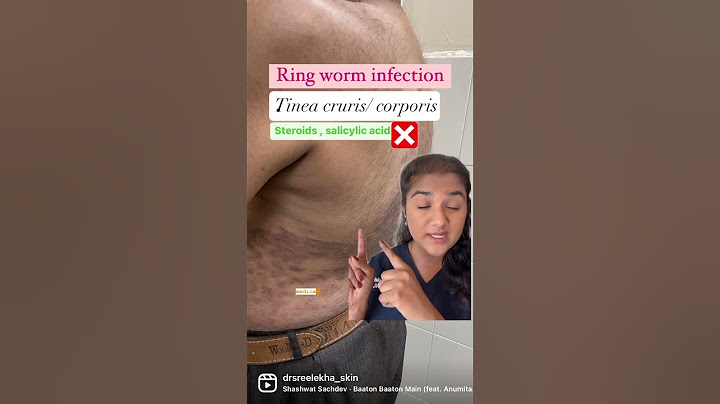 Ringworm infection treatment |how to get rid of it #antifungal #ringworm #fungal # #dermatologist