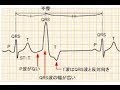 看護学生講座 ３ 心電図「心室性期外収縮(PVC)」