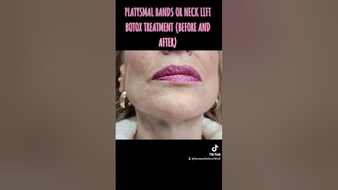 Platysmal bands or neck lift botox treatment before and after youtube