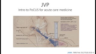 Evaluation of the JVP with PoCUS - An In-Depth Guide
