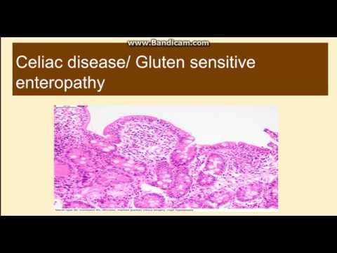 Video: Gluten-Sensitive Enteropathy Hauv Irish Teeb Tsa