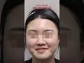 이마필러, 관자필러가 옆라인 앞라인 다 살려주네~