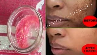 Éliminer Les Tâches Sombres, Les Tâches Noires, Les Cicatrices Dacné Naturellement Et Rapidement