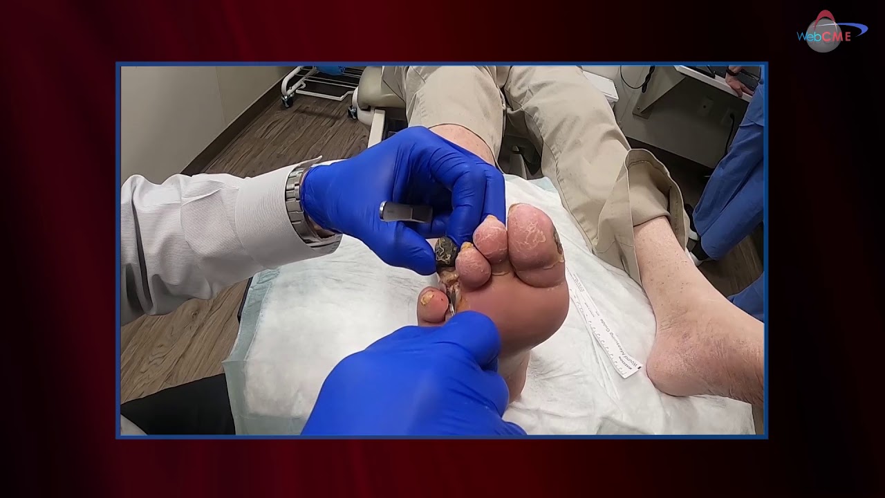 WCW: Amputating a Necrotic Toe