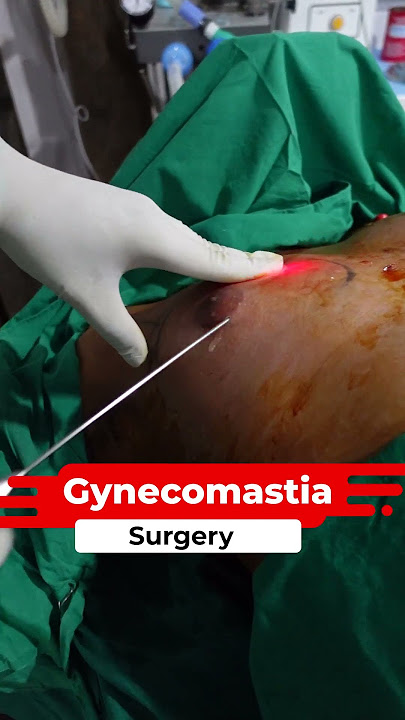 Gynecomastia Surgery | Gynecomastia Surgery cost #short #Short #shorts #share