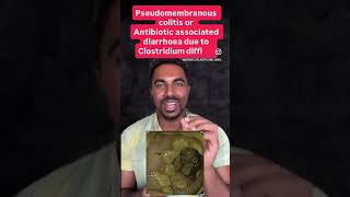Pseudomembranous colitis / antibiotic associated diarrhoea | clostridium difficile