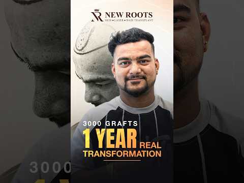 Receding Hairline Transformation | Hair Transplant in Nagpur | 3000 Grafts #hairline #shorts
