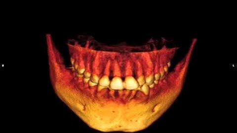 Supernumary lower 2nd premolars - impacted