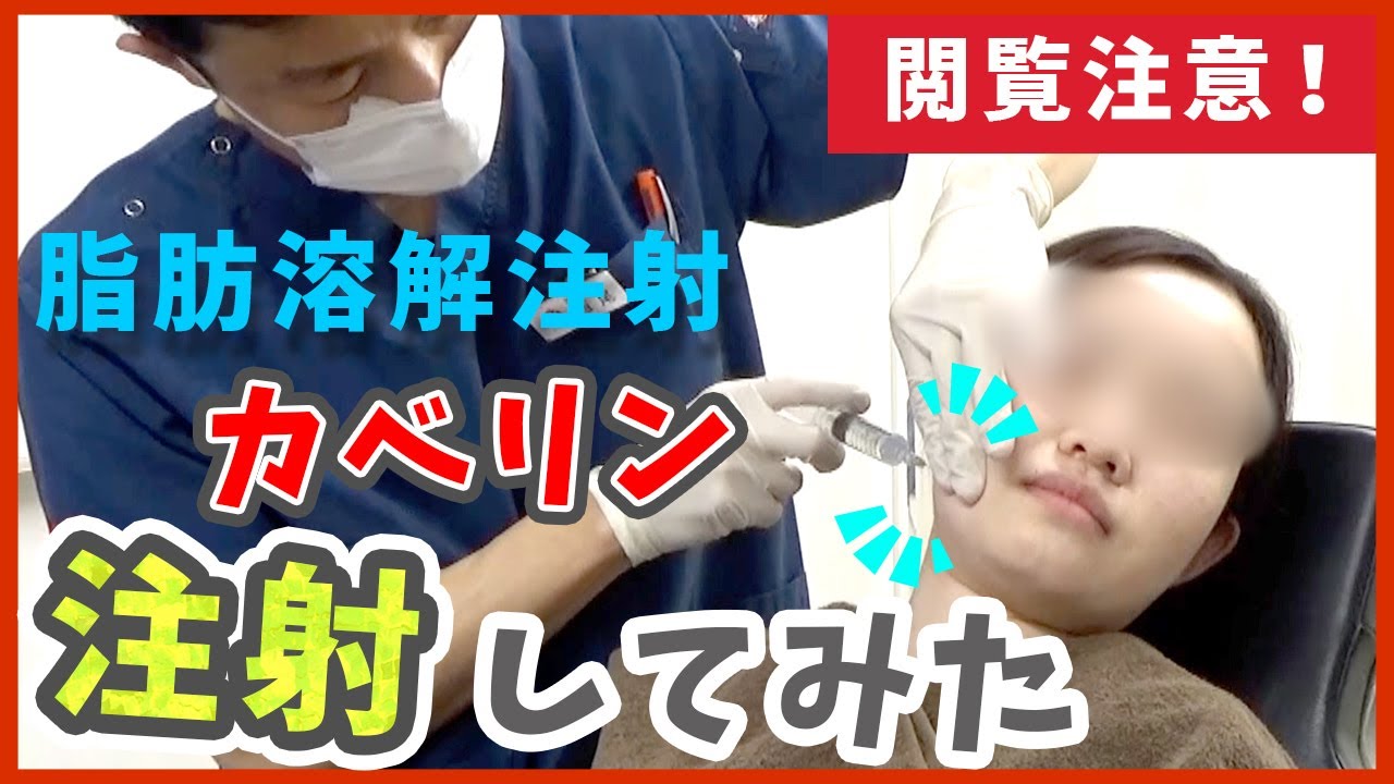 脂肪溶解注射（頬と顎下）のカベリン注入施術動画を公開します！【プチ整形】